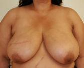 Feel Beautiful - Breast Reduction San Diego 14 - Before Photo